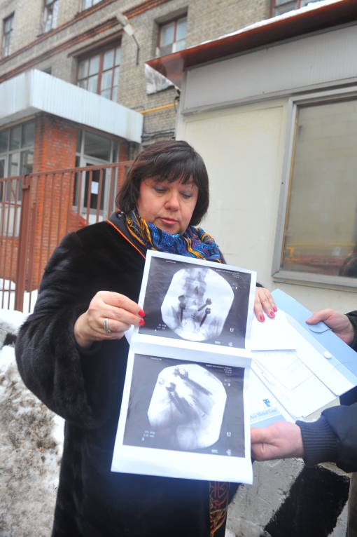 Рентгеновский снимок поврежденного участка позвоночника Плющенко